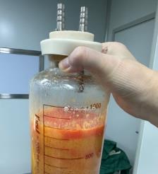 丰城水动力吸脂手术要做多久？